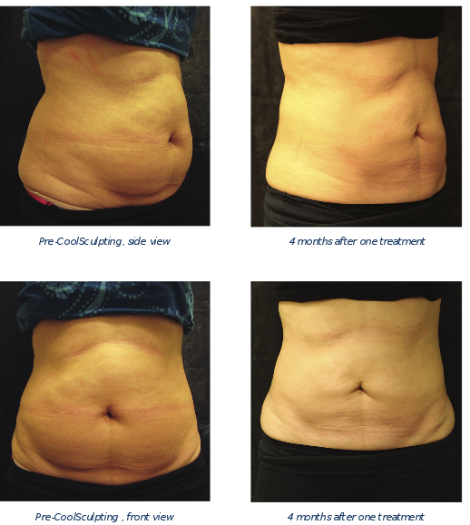 Coolsculpting Before and After Results From Actual Patients