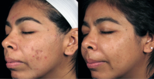 SilkPeel Before and After