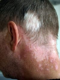 Skin Pigmentation Disorders