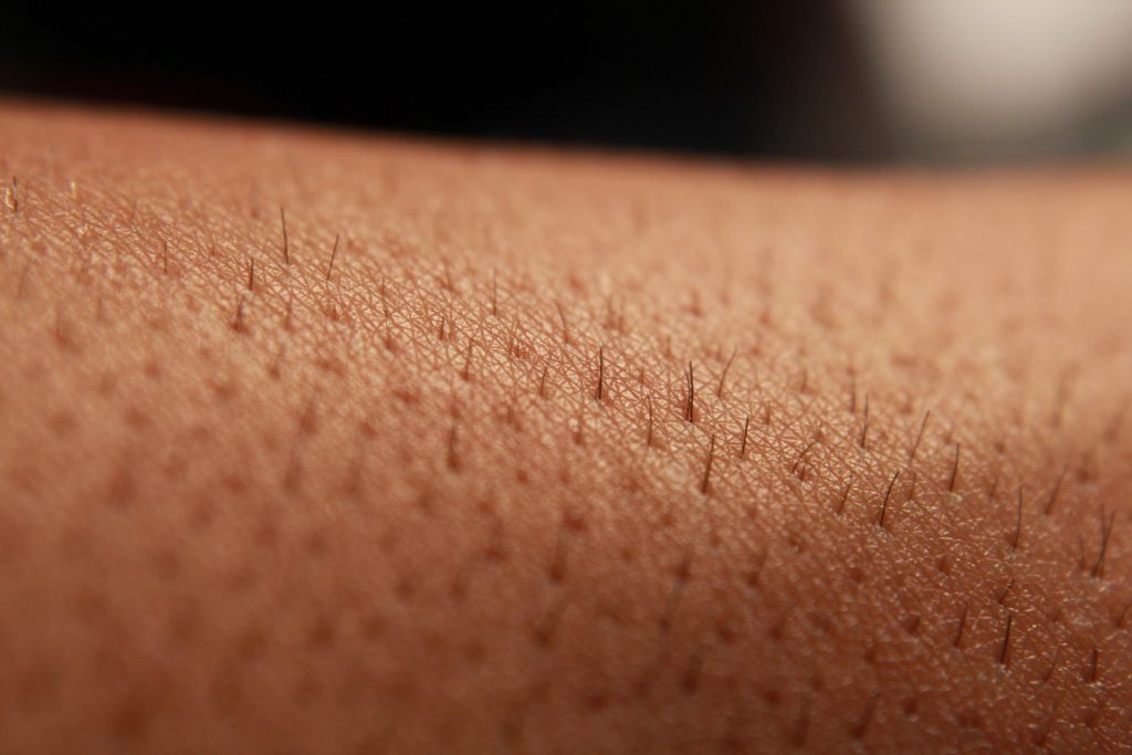 Understanding Folliculitis Inflamed Hair Follicles Dermatology Consultants