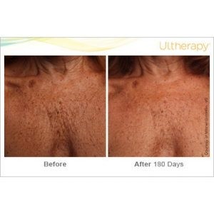 ultherapy