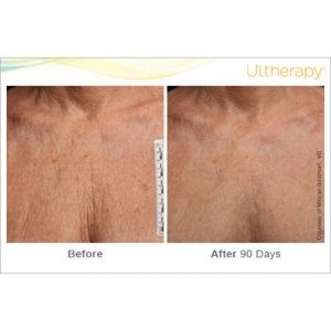 ultherapy