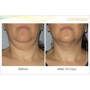 ultherapy