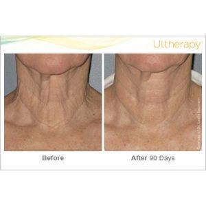 ultherapy