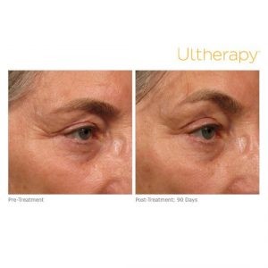 ultherapy