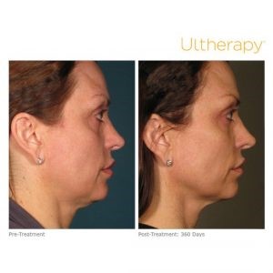 ultherapy