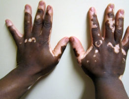 Vitiligo