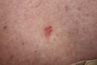 Basal cell carcinoma