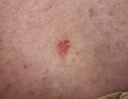 Basal cell carcinoma