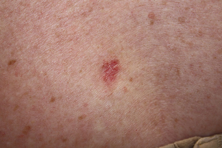 Basal Cell Carcinoma: Appearance and Treatment | Dermatology Consultants