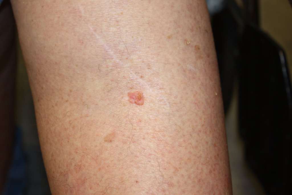 Squamous Cell Carcinoma Early Stages Early Skin Cancer Pictures And Squamous Cell Carcinoma Early Stages Early Skin Cancer Pictures And