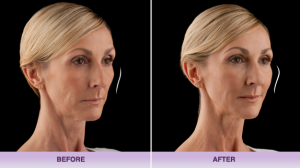 Juvederm Voluma XC